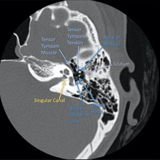 CT 3D Left Hip Joint